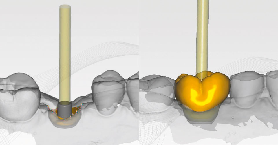 Fig. 9: La base adhesiva de titanio virtual como interfase entre el implante y la corona sobre pilar de cerámica híbrida.Fig. 10: La corona sobre pilar diseñada a partir de VITA ENAMIC IS, sobre la base de titanio.