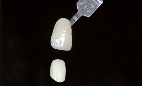 Ill. 3 : Adéquation parfaite du VITA Toothguide 3D-MASTER et de la couleur de la chape.