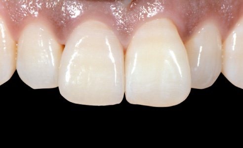 Fig. 11: Después: La restauración final en el diente 11; la paciente se mostró satisfecha con el resultado altamente estético.