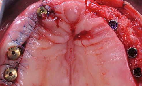 Abb. 4: Die sechs inserierten Implantate im Oberkiefer.