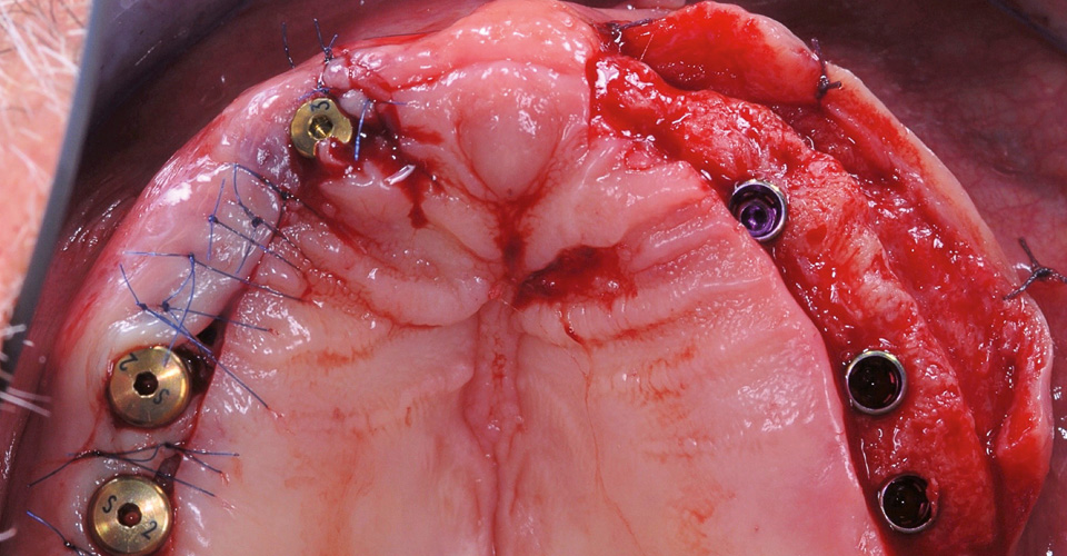 Abb. 4: Die sechs inserierten Implantate im Oberkiefer.