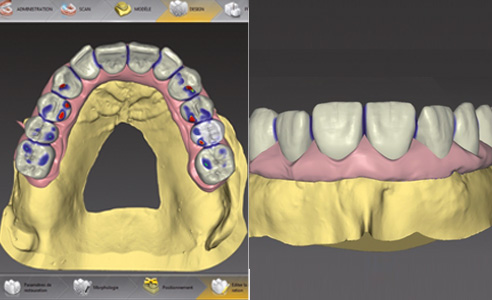 Fig. 6:  Diseño asistido por ordenador de la estructura del maxilar superior.
Fig. 7: Vista vestibular de la planificación virtual de la estructura.