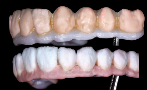 Abb. 12: Verblendung der Zahnfacetten mit BASE DENTINE A2 und A3.
Abb. 13: Finale Schichtung mit Schmelz- (ENL, EO1) und Gingivamassen (G3).