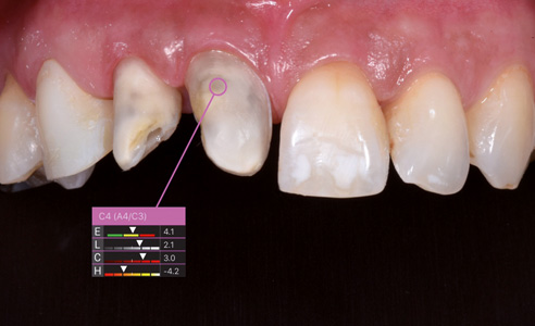 Fig. 1: Tras un accidente, los dientes de las regiones 11 a la 13 estaban  desvitalizados y debían tratarse con carillas. Dado que los muñones dentales 11 y 12  eran demasiado grises, fueron tratados previamente mediante blanqueamiento interno.