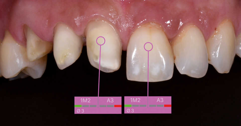 Fig. 2: Tras el blanqueamiento se obtuvo un color de los muñones armonizado. Este es tan importante para el protésico como el color del diente adyacente, y también puede comunicarse mediante la aplicación o por correo electrónico.