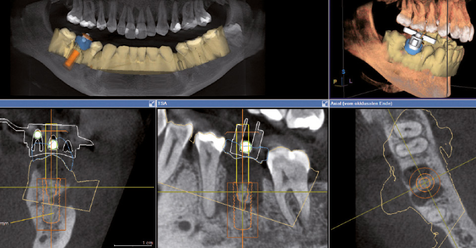 Fig. 2: El implante virtual posibilita un protocolo de taladrado guiado.