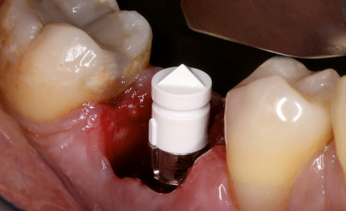Abb. 4: Postoperativ aufgeschraubter Scanbody zur digitalen Erfassung der Implantatposition.