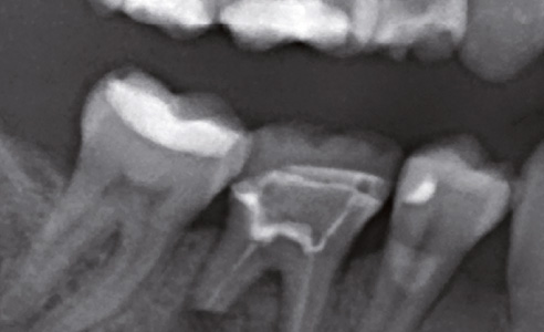 Fig. 1: Situación tras la resección de los ápices radiculares del diente 36.