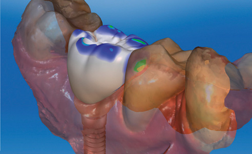 Fig. 9: Final abutment crown with occlusal and approximal contacts.