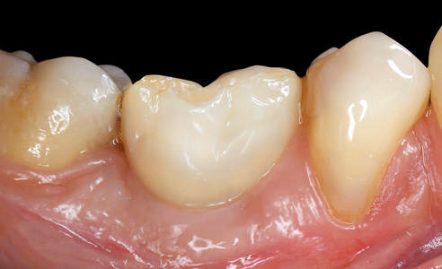 Fig. 12: Armonía roja y blanca tras las colocación del diente 36.