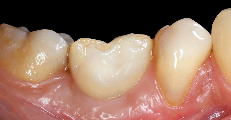 Fig. 12: Armonía roja y blanca tras las colocación del diente 36.