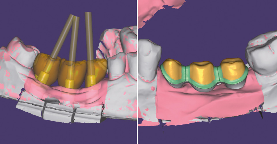 Fig. 3: Progettazione delle corone implantari nelle regioni 45, 46 e 47.
Fig. 4: Progettazione della sottostruttura.