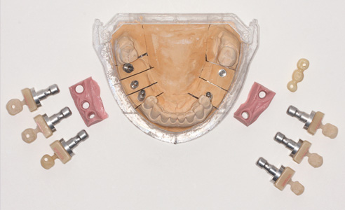 Fig. 7: Implant crowns as well as a bridge framework of VITA YZ, all with veneer shells of VITA ENAMIC.