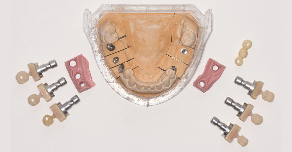 Abb. 7: Implantatkronen sowie ein Brückengerüst aus VITA YZ samt Verblendschalen aus VITA ENAMIC.