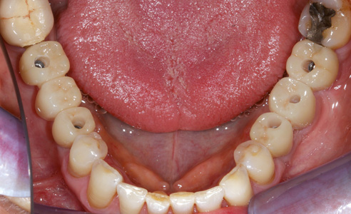 Ill. 9 : Situation après le scellement de toutes les restaurations dans la bouche de la patiente.