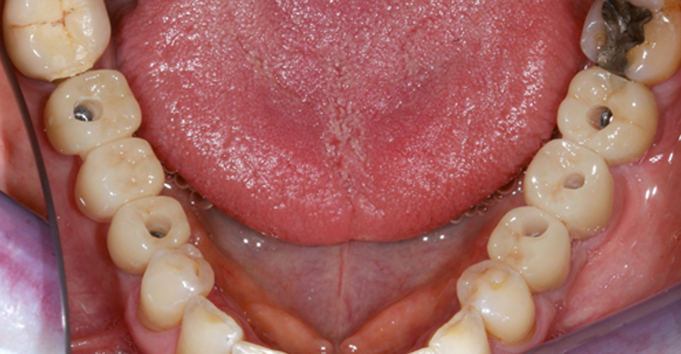 Fig. 9: Situazione dopo il fissaggio di tutti i restauri nella bocca del paziente.