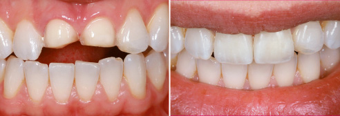 Fig. 1: Situación de partida: Situación clínica tras la preparación de carillas en los dientes 11 y 21.
Fig. 2: Resultado: La sonrisa con un juego cromático y de luces natural.