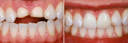 Fig. 4:  Situación clínica tras la preparación de carillas en los dientes 11 y 21.
Fig. 5: Prova dei restauri in ceramica ibrida VITA ENAMIC su 11 e 21.