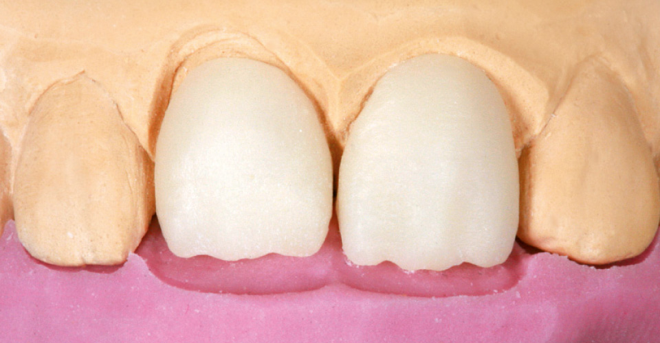Fig. 6: Both restorations after the individual, incisal cut-back using diamond tool.