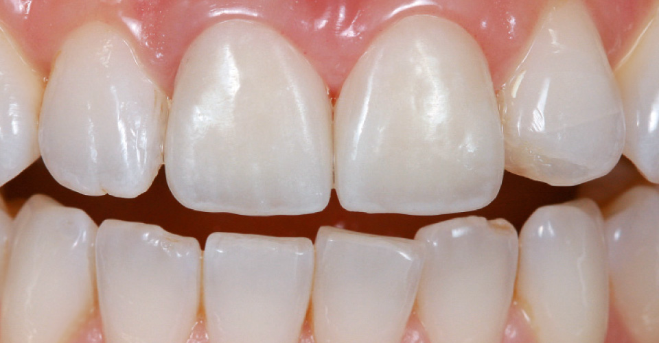 Fig. 9: Restauración final en los dientes 11 y 21 con translucidez juvenil.