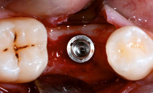 Abb. 2: Geplant wurde die Versorgung des Implantats mit einer direkt verschraubten Krone aus Hybridkeramik.