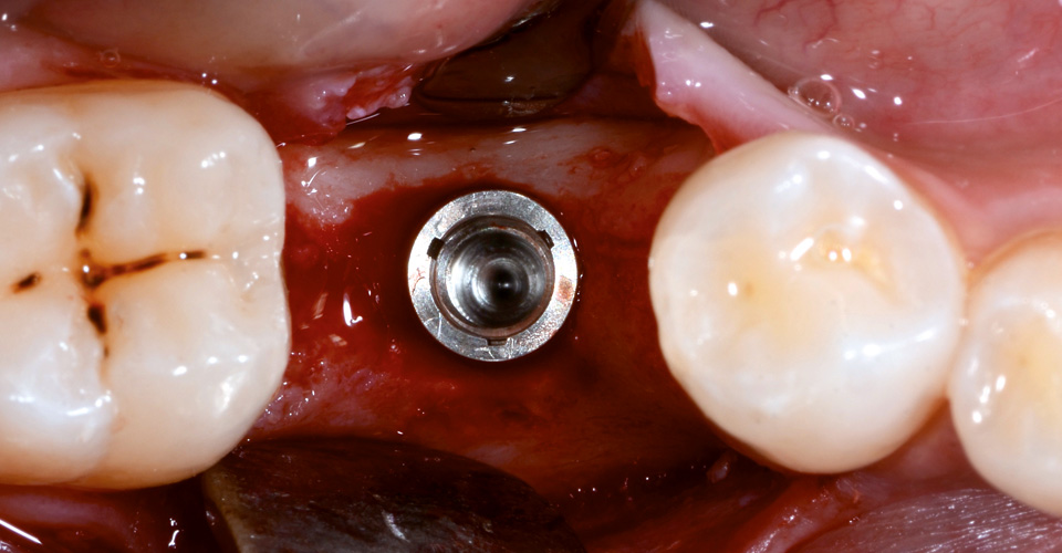 Fig. 2: We planned the restoration of the implants with a directly screwed crown of hybrid ceramic.
