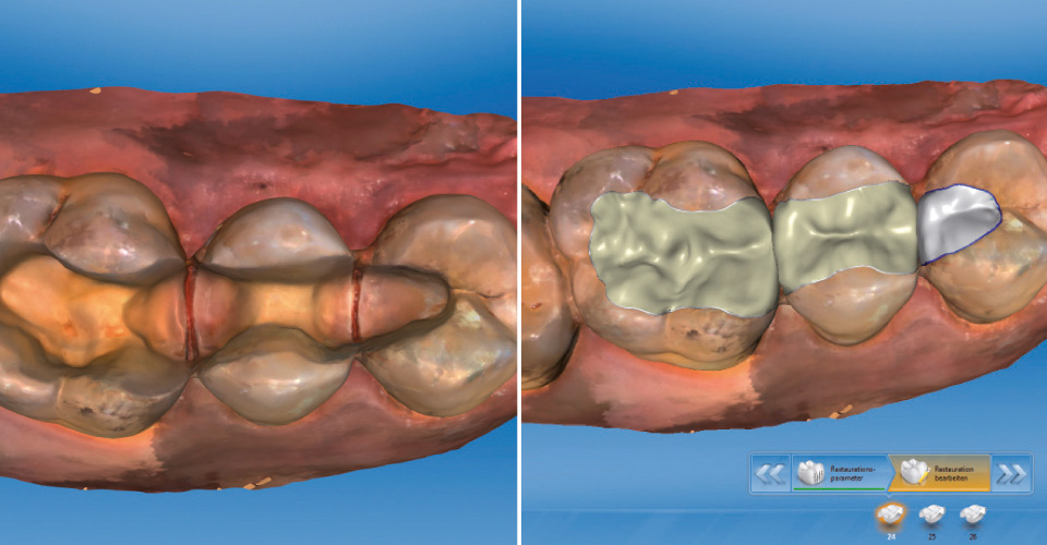 Fig. 5: The digital impression was made with an intraoral scanner.
Fig. 6: The chewing surfaces were reconstructed using the biogeneric software.
