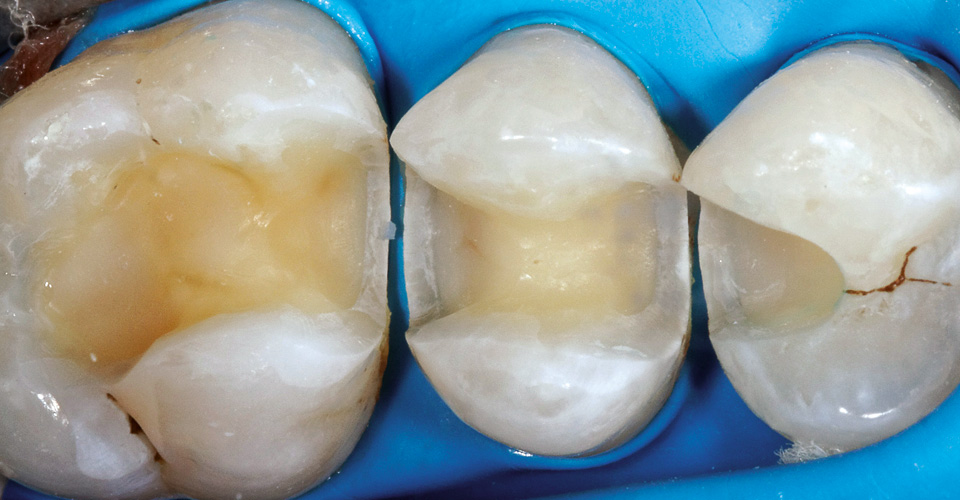 Ill. 9 : Pour le scellement adhésif, une digue dentaire assure un assèchement absolu.