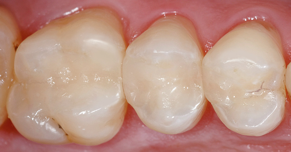 Fig. 10: Result: A defect-oriented restoration with composite fillings was planned. 
The result was a minimally invasive restoration with VITA ENAMIC inlays.