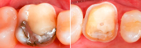 Fig. 2: Obturación insuficiente de composite y amalgama en el diente 16.
Fig. 3: Construcción del muñón y preparación del diente 16.