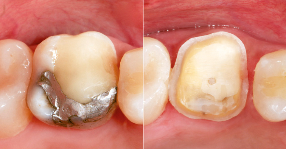 Fig. 2: Otturazione insufficiente in composito e amalgama, dente 16.
Fig. 3: Ricostruzione del moncone e preparazione del dente 16.