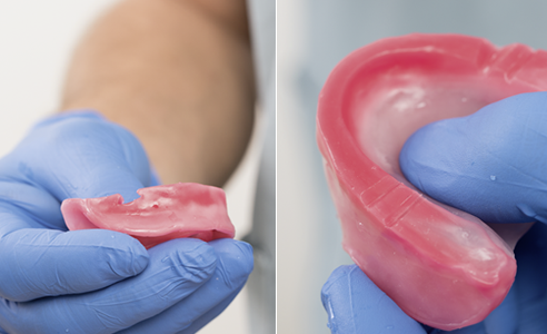 Fig. 6: A retentive undercut was incorporated in the mandibular wax rim to affix the registration silicone.
Fig. 7: Triangular grooves in the maxillary bite template allowed for clinical repositioning and testing of the centric.
