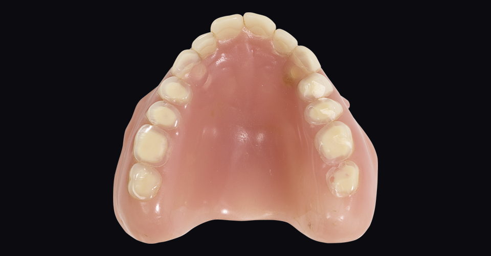 Fig. 3: The esthetically and functionally insufficient prostheses showed massive occlusal abrasions.