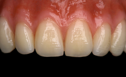 Fig. 2: Il nuovo dente anteriore ha forme molto belle, soprattutto riguardo l'armonioso rapporto estetico lunghezza-larghezza.