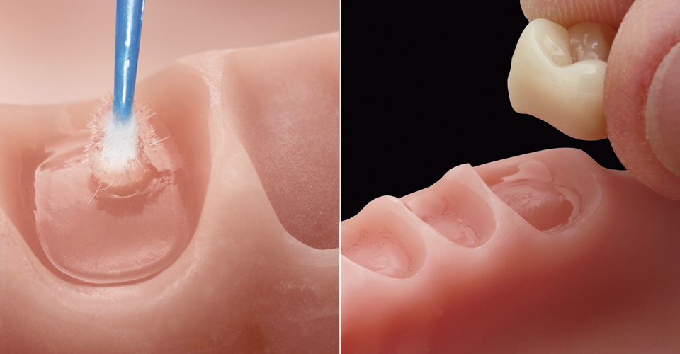 Fig. 11: Los alveolos de PMMA fresados se humedecieron con VITA VIONIC BOND …
Fig. 12: … y los dientes arenados por basal se fijaron adhesivamente en la cavidad con un ajuste preciso.
