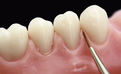 Fig. 13: Closing of the interdental spaces with veneering composite VITA VM LC flow.