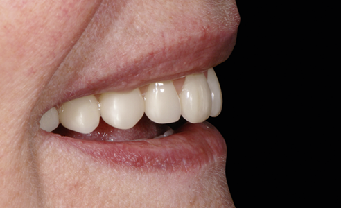RÉSULTAT : la patiente s'est montrée enchantée de l'assise stable et de l'effet naturel des dents prothétiques VITAPAN EXCELL.
