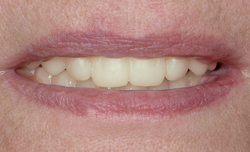 Fig. 8: La prueba en cera confeccionada mediante CAD/CAM a partir de VITA VIONIC WAX white, en boca de la paciente.