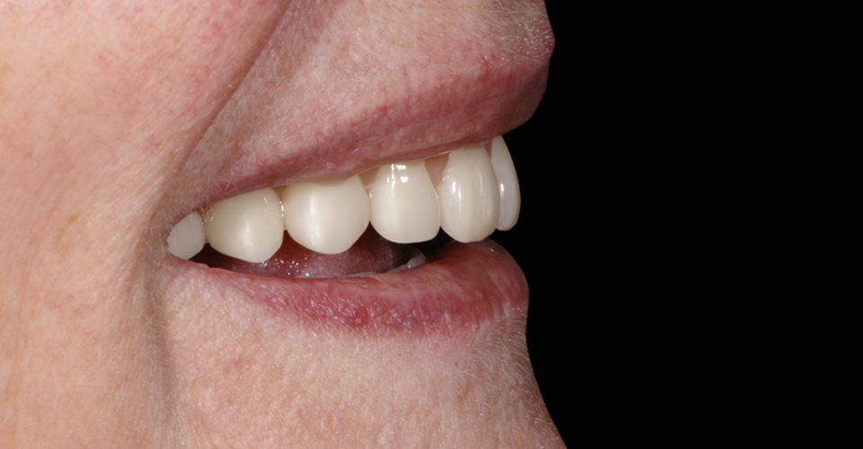 RÉSULTAT : la patiente s'est montrée enchantée de l'assise stable et de l'effet naturel des dents prothétiques VITAPAN EXCELL.