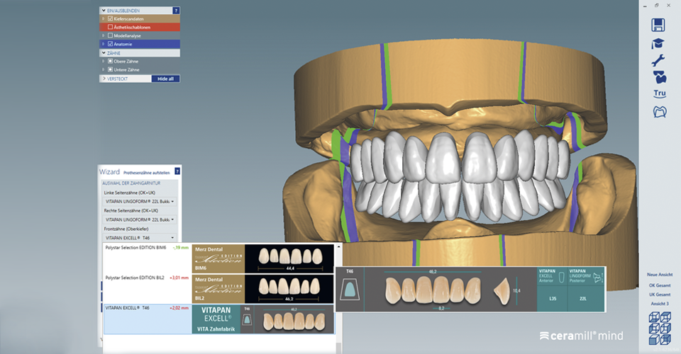 Fig. 4:El montaje virtual se llevó a cabo pulsando un botón tras la elección de los dientes.