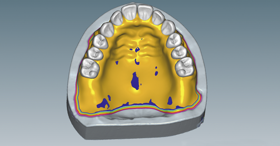 Fig. 5: Functional margins and dimensioning of the denture base were digitally designed.