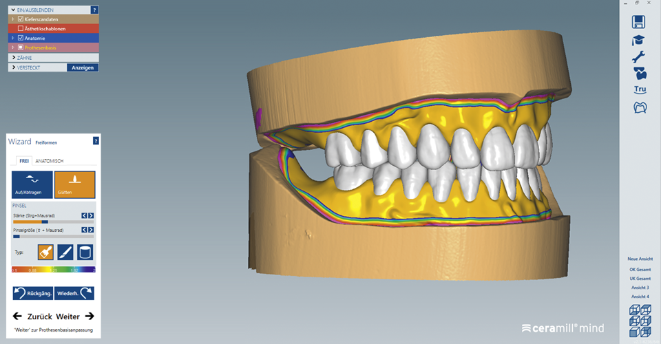 Fig. 1: Example of CAD prosthesis design using Ceramill Mind software.