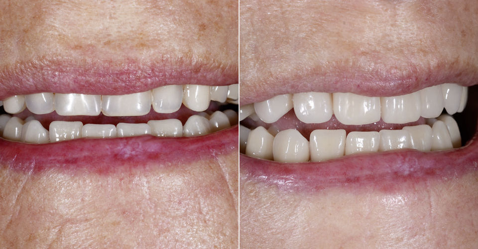 INITIAL SITUATION: The insufficient restorations showed a midline displacement and functional disharmonies. 
RESULT: The patient was very happy with the naturalness of the new restoration.