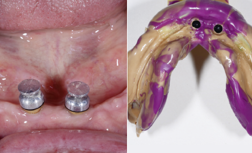Ill. 2 : Deux implants ont été insérés dans la région incisale pour stabiliser fonctionnellement la réhabilitation  dans la mâchoire inférieure.
Ill. 3 : Une empreinte mandibulaire de fixation muco-dynamique a été réalisée avec un porte-empreinte individuel.
