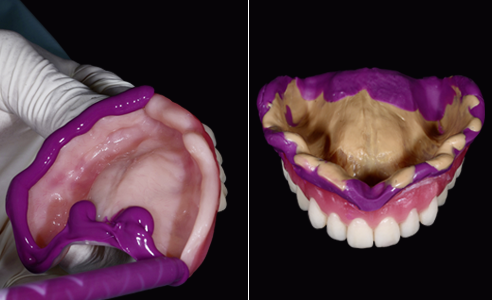 Fig. 8: Tras la prueba en boca, se tomó en el maxilar superior una impresión mucodinámica con el montaje.
Fig. 9: La impresión mucodinámica final conforme a la oclusión en la base de prótesis duplicada.