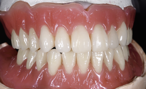 Fig. 7: The final wax setup in the articulator with molded gingival anatomy before the try-in.