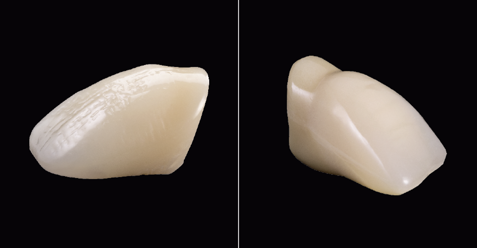 Abb. 5, 6: VITAPAN EXCELL mit natürlicher Halsgestaltung versus SR VIVODENT DCL mit stark abgesetztem Zahnhals.