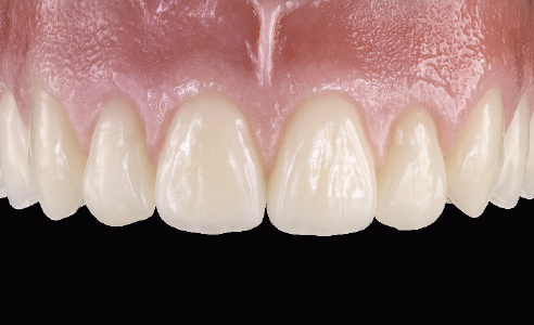 Fig. 7: Natural gingiva design with VITA PHYSIODENS.
