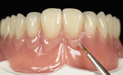 Fig. 3: The stability of the thixotropic veneering composite allows for a precise application.