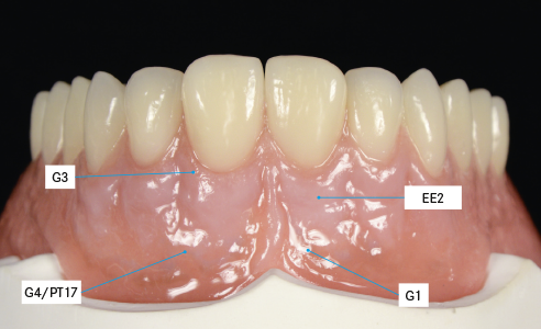 RESULT: The natural gingival portions were efficiently reconstructed. The final result shows the harmony between the red and white esthetic.